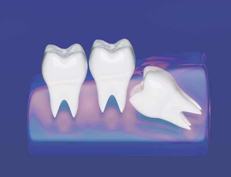 illustration of an impacted wisdom tooth